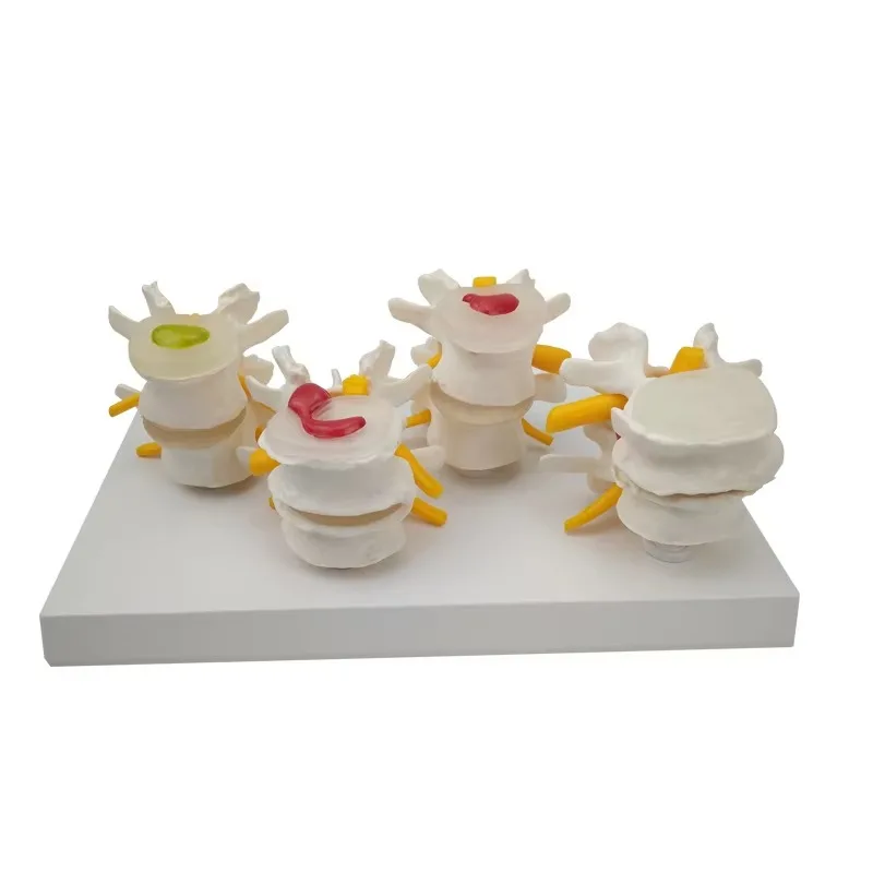 

4-stage Pathological Human Lumbar Spine Anatomy Model Medical Science Teaching Resources Dropshipping