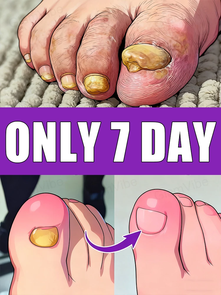 

When nails show discoloration, peeling or breakageᴰⁱˢⁱⁿᶠᵉᶜᵗ ᵃⁿᵈ ᵖʳᵒᵗᵉᶜᵗ ᵃˢ ᵉᵃʳˡʸ ᵃˢ ᵖᵒˢˢⁱᵇˡᵉ