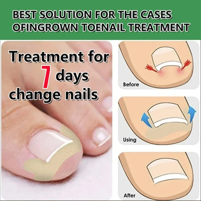 Ingrown nail stickers, invisible nail correction stickers, ingrown nail correction tape, onychomycosis repair and correction,