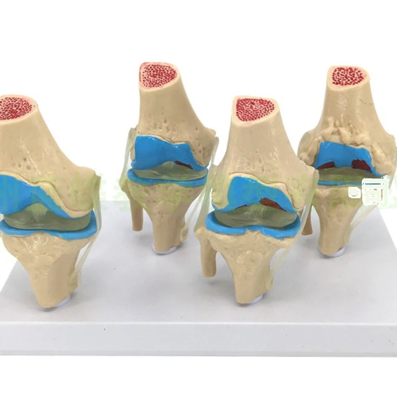 1PC Anatomical Human Knee Joint Model Human Stage 4 Knee Joint Model for School Teaching Display Models Disease Process