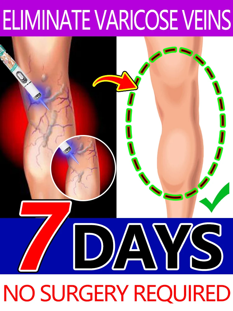 

blue light pen solve varicose veins,2025 NEW hot sale leg care tools