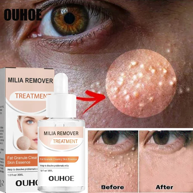 Fat Granules Removal Eye Serum Anti Dark Circle Eye Bags Fade Fine Line Essence Anti-Puffiness Moisturizing Skin Care Products