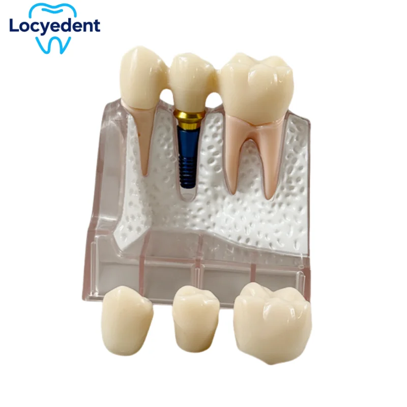 

Dental Demonstration Model 4 Times Teach Implant Analysis Crown Bridge Detachable Model Dentistry Teaching Study Training Models