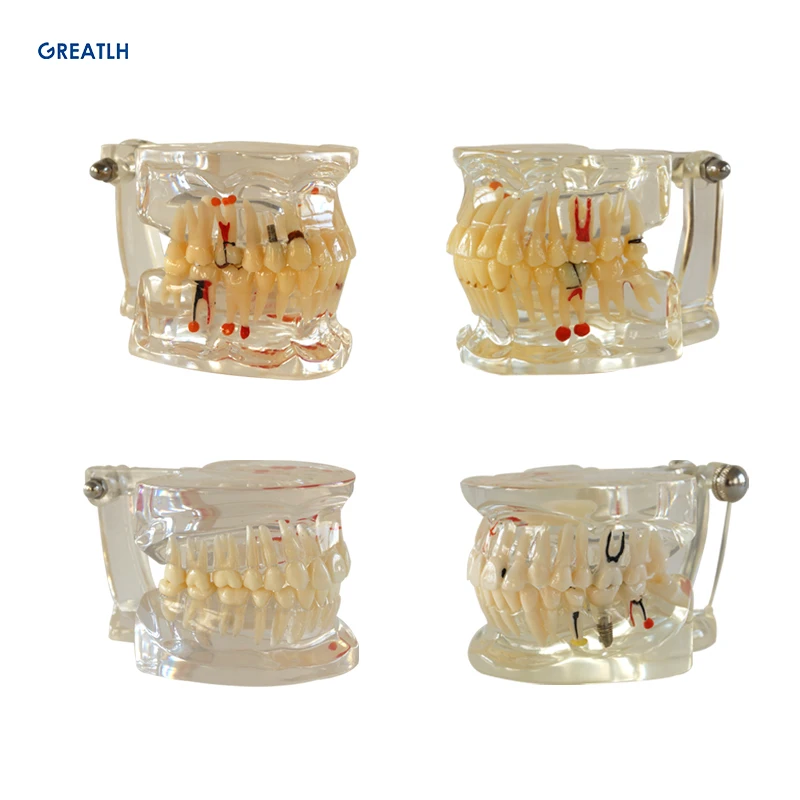 

Dental Oral Care Tooth Teeth Model Dental Orthodontic Model for Patient Communication Dentist Study Model