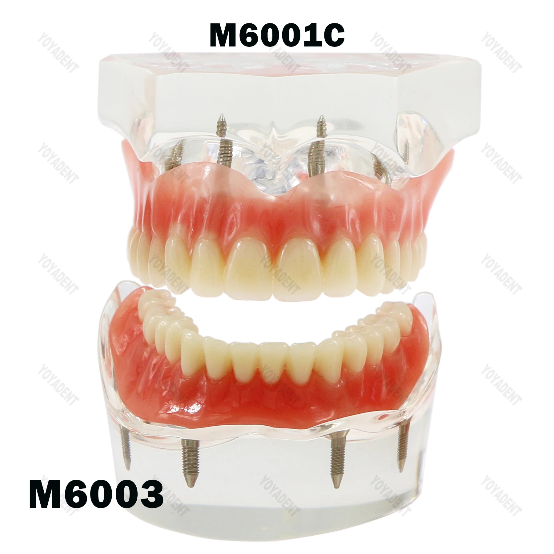 Dental Teeth Model With 4 Implants Overdenture Restoration Bridge For Dentist Implant Treatment Demo Dentistry Accessories