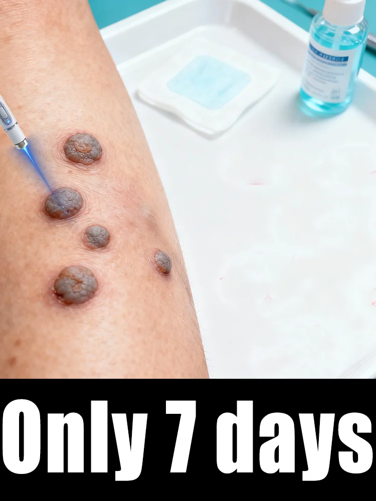 Gᴇɴᴇʀᴀᴛɪᴏɴ-2 Lᴀsᴇʀ Sᴀʏs Gᴏᴏᴅʙʏᴇ Tᴏ ᴀʟʟ ᴡᴀʀᴛs Iɴ 7 Dᴀʏs