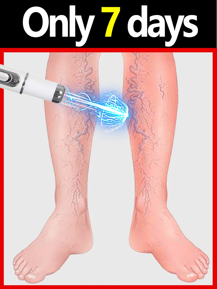 

Новинка 2026: Усовершенствованный прибор для лечения венозных проблем синим светом, 2-е поколение, хит продаж за 7 дней