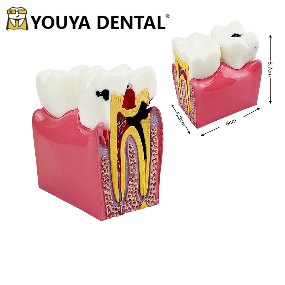 6 Times Caries Comparison Model Disease Teeth Model for Dentist Student Teaching Practice Studying Demonstration Module