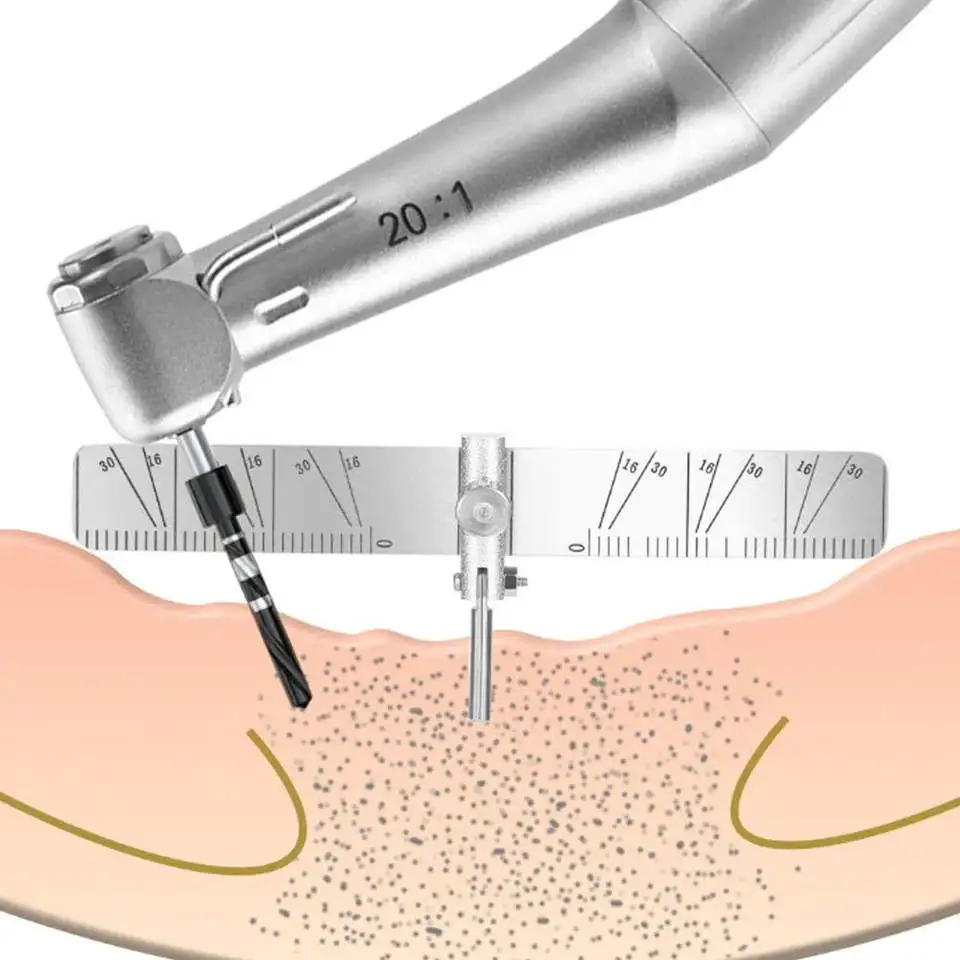 Przewodnik lokalizujący Implant dentystyczny po autoklawie lokalizator do sadzenia chirurgicznego 2 linijka kątowa dla dentysty