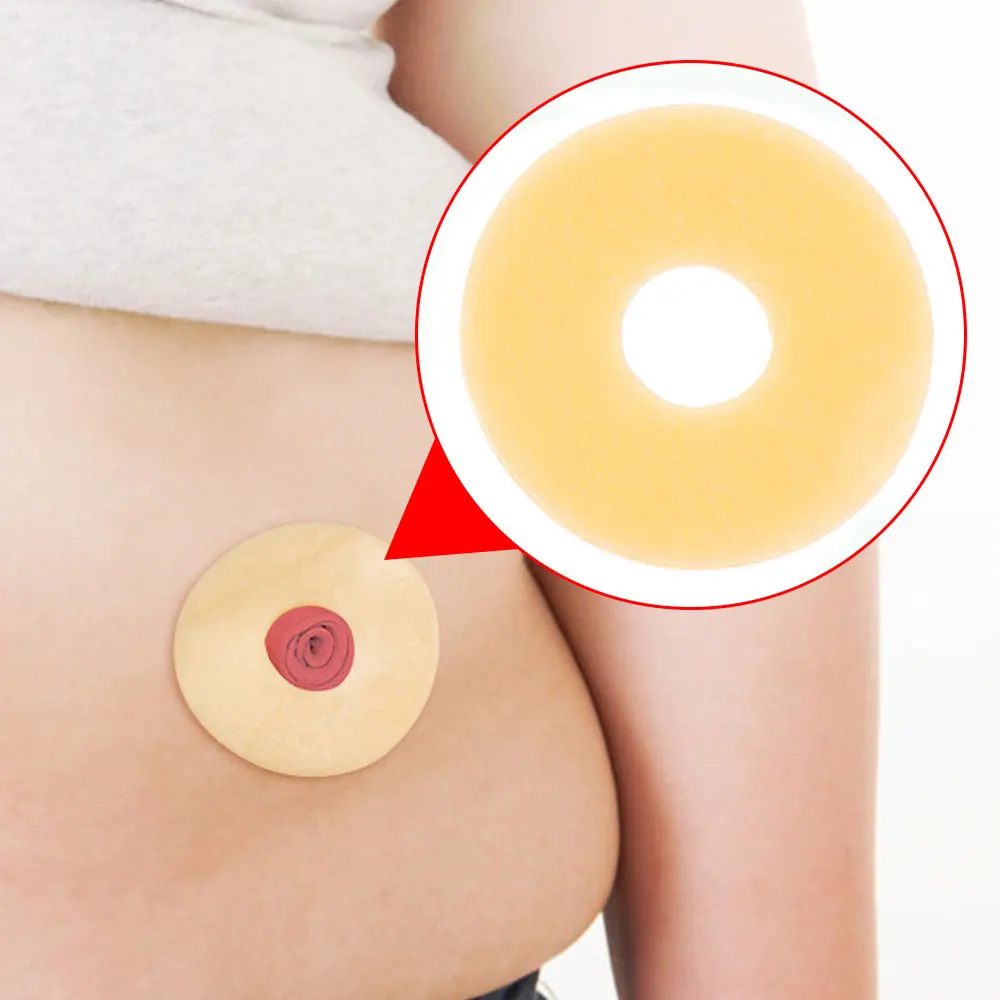 5-50Pcs Ostomy Bag Leak Proof Sealing Sticker 2/4mm Colostomy Bag Anti-leak Ring Paste Stoma Bags Protective Barrier Rings