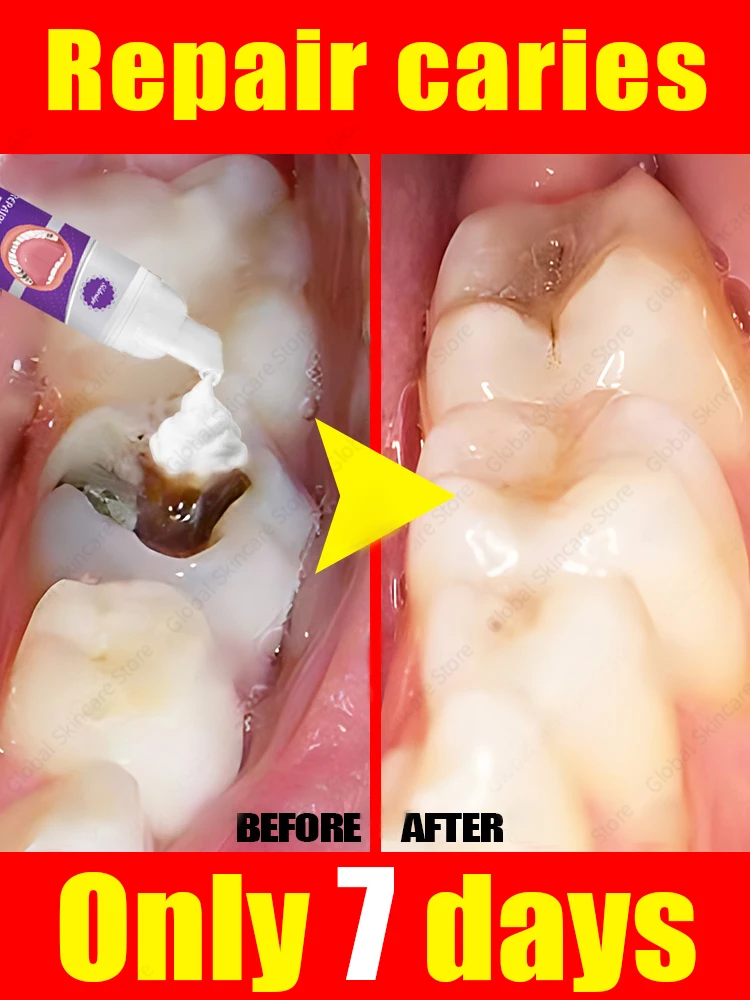 tooh Decay repair