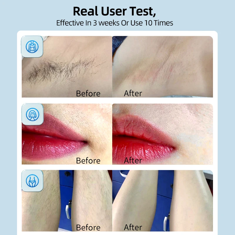 جهاز ليزر MLAY T14 لإزالة الشعر آلة إزالة الشعر الدائم IPL 500000 ومضات تبريد الثلج غير مؤلمة Depilador آلة ليزر