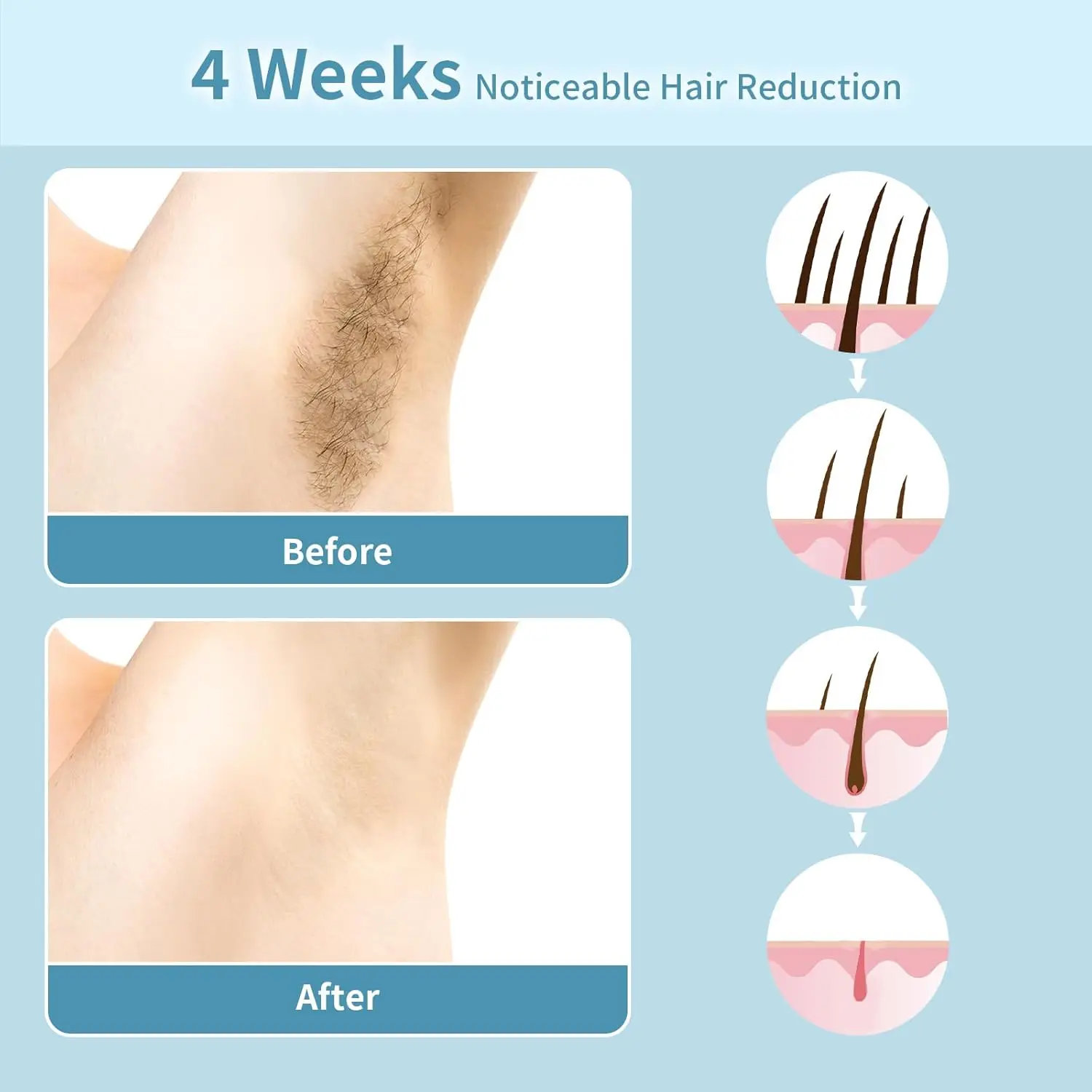 جهاز إزالة الشعر IPL للنساء والرجال، 3 في 1 غير مؤلم في الاستخدام المنزلي، تبريد الوجه، الذراعين، الساقين، خط البيكيني - هدية مثالية