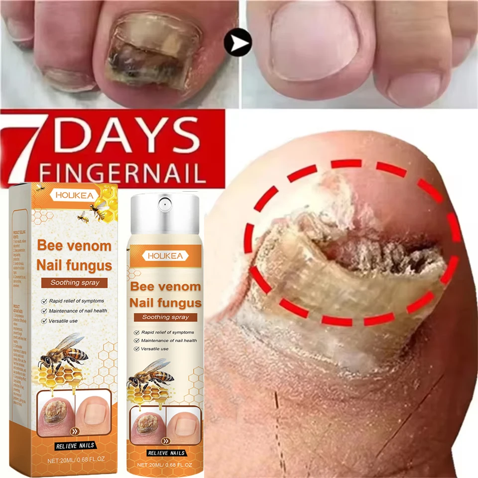 真菌性爪治療血清スプレー足の爪真菌除去修復ジェル抗感染症爪周囲炎爪甲真菌症足の爪ケア