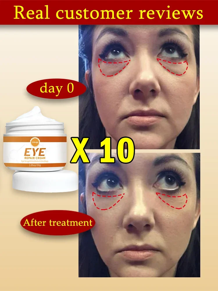 Skin whitening cream to remove eye problems skin care beauty health