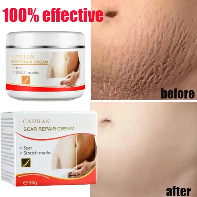 Stretch Marks Permanent Removal Cream Eliminate Body Belly Stretch Marks Swelling Marks Remove Skin Cracks Repair Firming Care