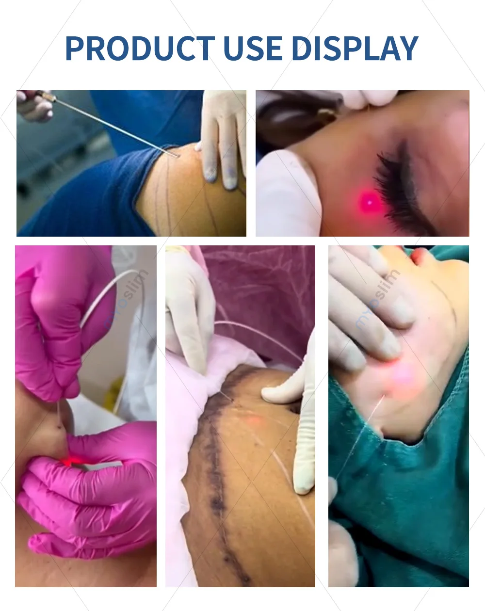 

Accessory 980 1470 NM Weight Loss and Slimming Fat Dissolving Fiber Optic Fiber