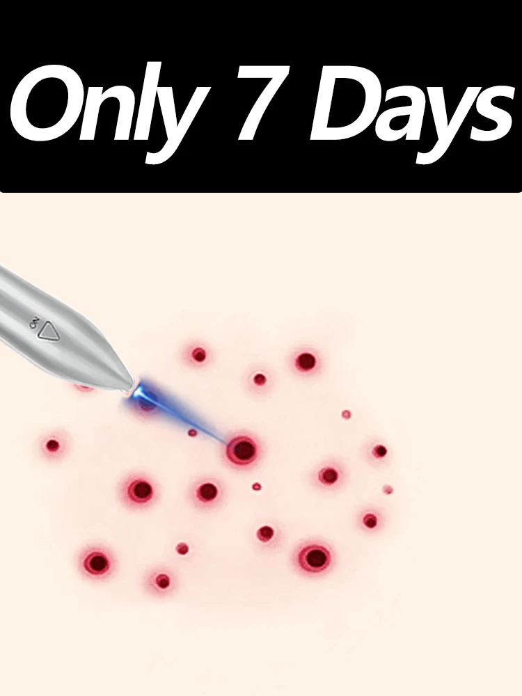 

The latest high-tech beam pen laser solves problem