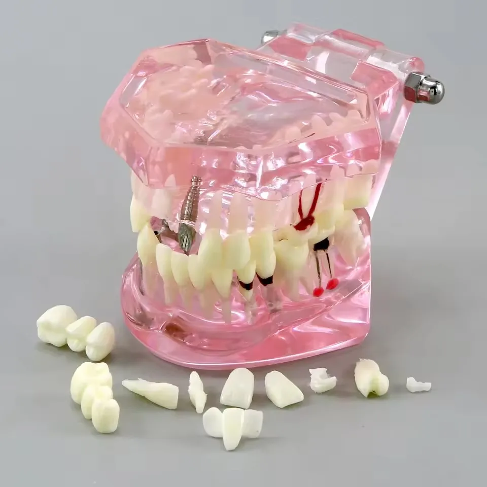 Teeth Repair Model Disease Teeth Model for Dentist Student Practice Training Studying Oral Medical Dentistry Tools