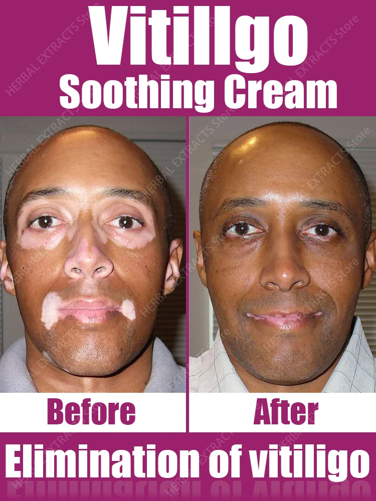 Creme para vitiligo melhora manchas brancas