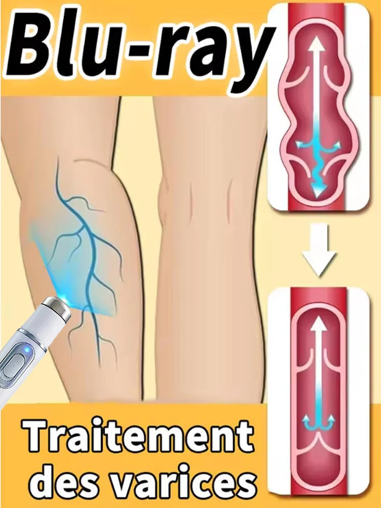 

The new second generation varicose vein laser device solves varicose veins, spider legs and other problems