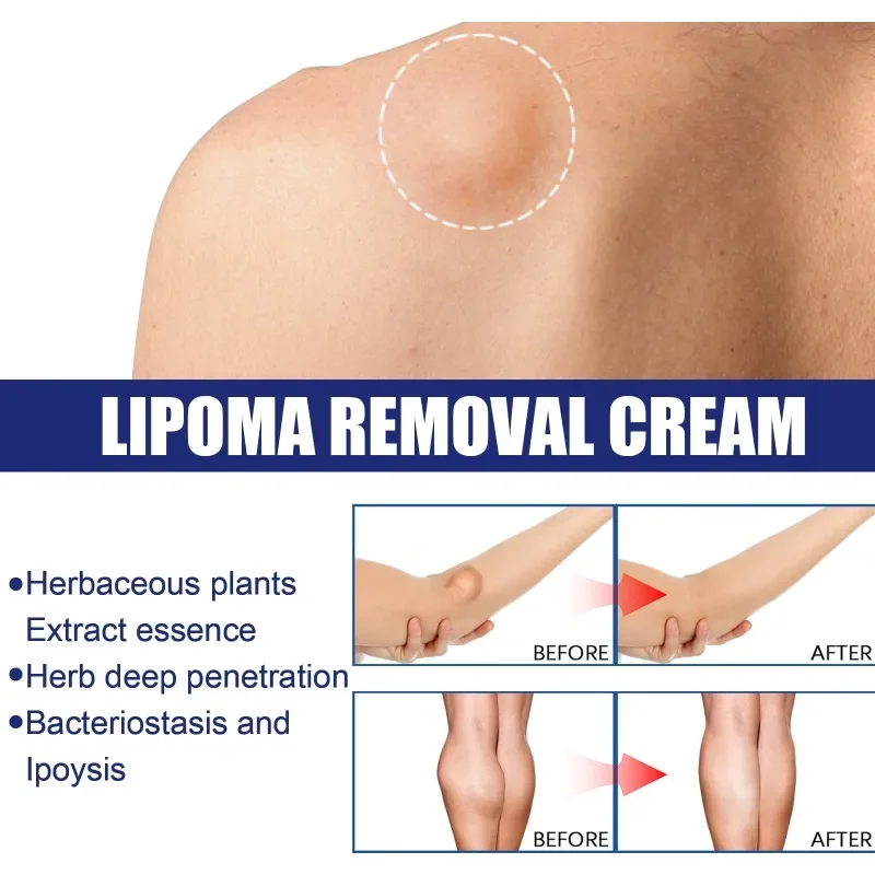 Pomada de eliminación de Lipoma, tratamiento de celulitis, eliminador de Fibroma, bultos subcutáneos, múltiples Lipomas, masa de grasa, crema de medicamentos, 20G