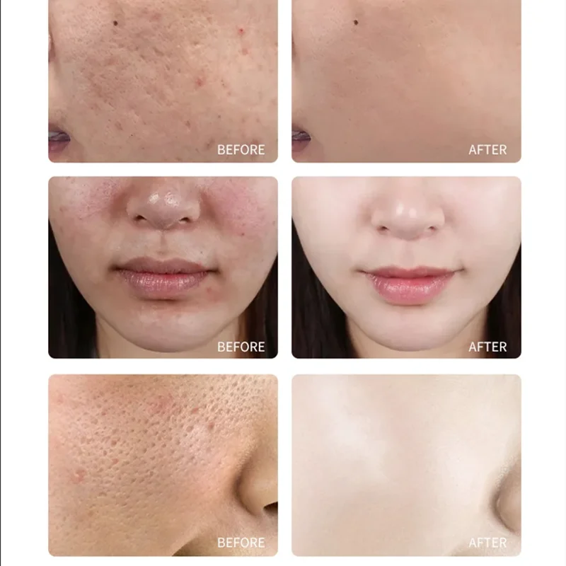 20% TCA Aid Skin Peel Pores 30ml Trichloroacetic Acid Stock Solution Minimizing Blackheads Solution Improve Shrink Pores