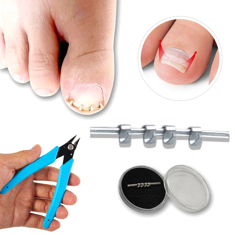 1PCS Professionelle Eingewachsene Kappe Nagel Korrektur Draht Fixer Behandlung Werkzeug Pediküre Paronychie Erholen Zehennägel Corrector Reusable