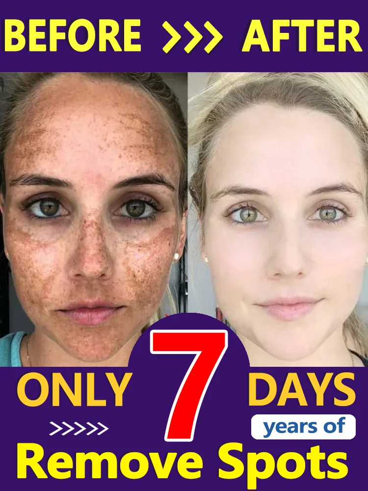 Crema para eliminar pecas, Melasma