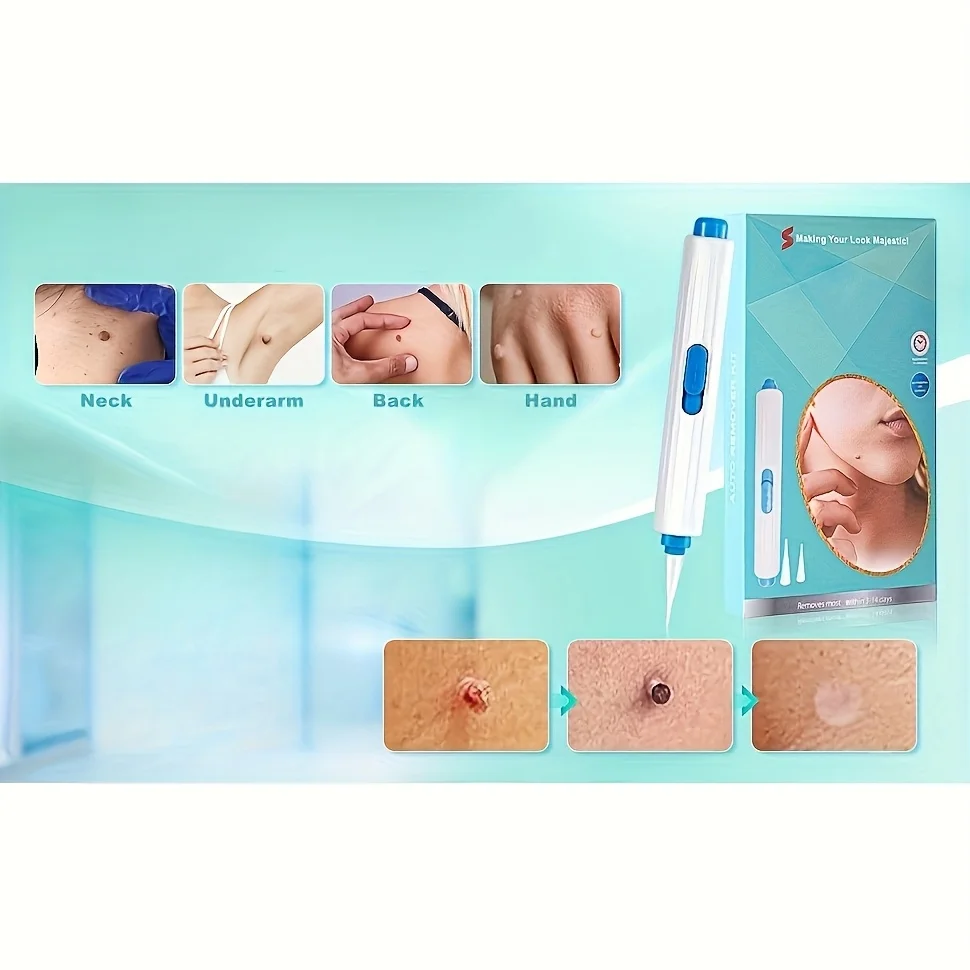 Kit d'élimination 1/2/4 pièces pour les soins de la peau, conception conviviale à une main, sûr et efficace pour un usage domestique