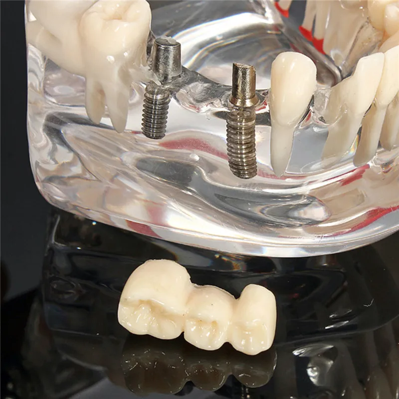 Dental Implant Model with Realistic Teeth for Dentist Training and Dental Disease Education