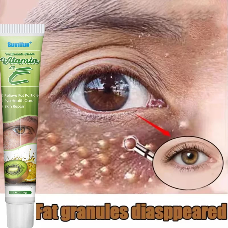 Fat Granules Remover Eye Cream Effective Remove Fat Granules Puffiness Anti-Particles Milia Remover Product Repair Eye Skin Care