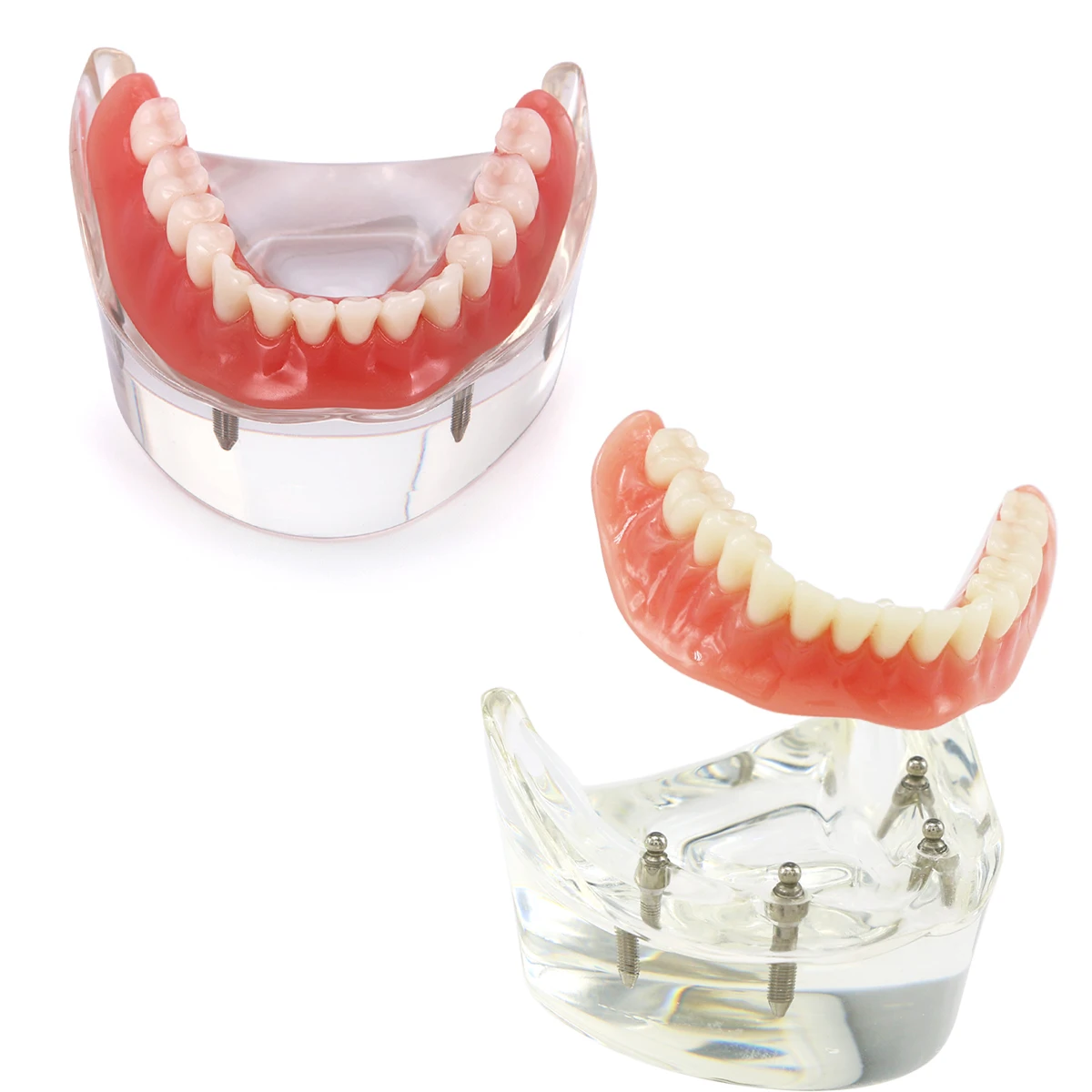 Dental Model Teeth Implant Restoration Dental Prosthesis Model   For Dentist Patient Communication Treatment Study Demo