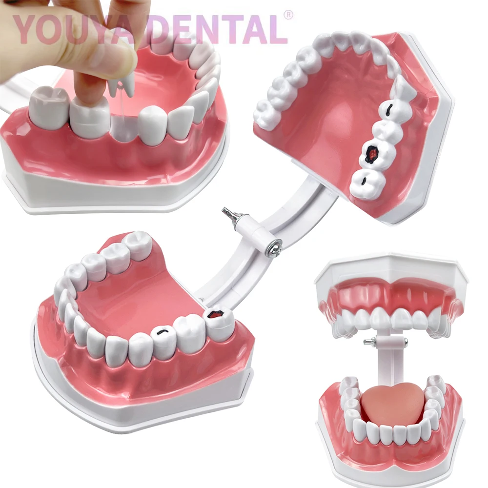 Dental Brushing Education 2 Times Teeth Model With Toothbrush Detachable Teeth & Tongue Caries Pathology Research Training Model