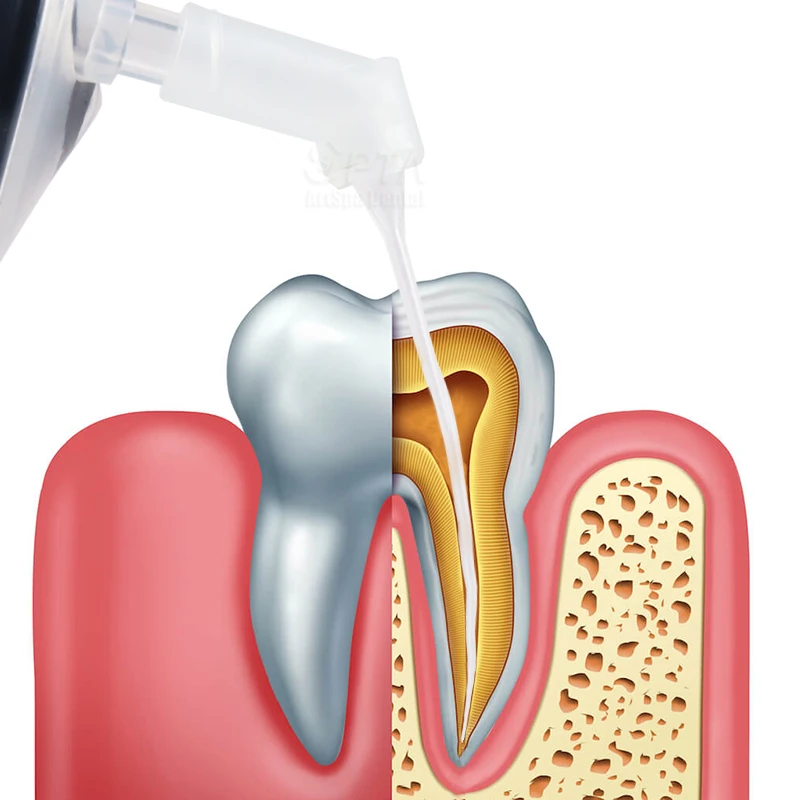 10ชิ้นต่อซอกฟันแบบยืดหยุ่นได้สำหรับทันตแพทย์ทันตแพทย์ทันตแพทย์ปลายชลประทานวัสดุที่เกี่ยวกับรากฟันเข็มฉีดยาล้างคลองรากฟัน
