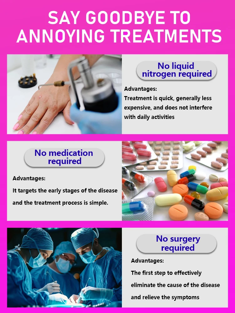 إزالة الثآليل الضوئية، استعادة البشرة الناعمة، إزالة الثآليل الدقيقة، فعالة وخالية من القلق #3