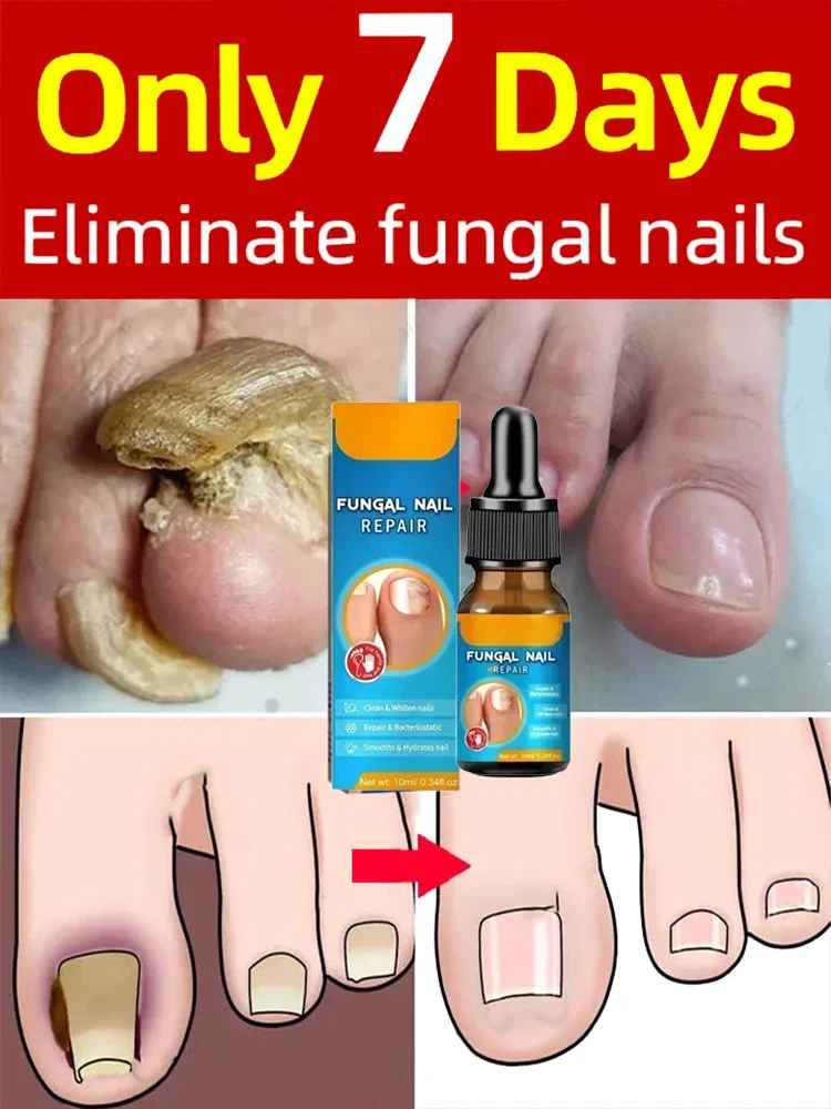 Tratamiento de uñas con hongos, suero de esencia, solución antiinfección para reparación de onicomicosis y paroniquia, tratamiento de hongos en las uñas del pie