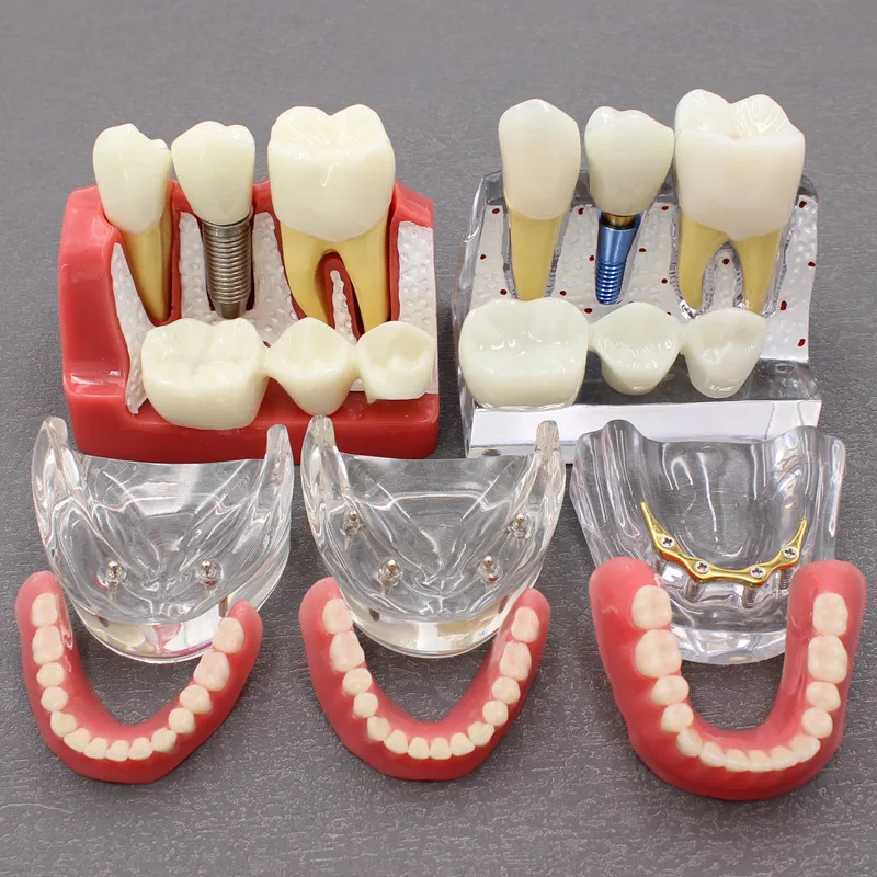 Dental Teeth Model With Implants Overdenture Superior Demo Model For Student Dentist patient communication model