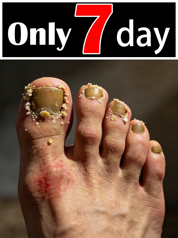 

Хит продаж 2025 года: Попрощайтесь с проблемами с ногтями – просто и удобно