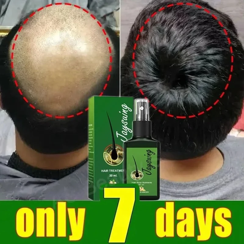 

Fast Ginger Hair Growth Spray Roots Grow Anti Hair Loss Hair Regrowth Serum Scalp Damaged Repair Nourish Care Products Women Men