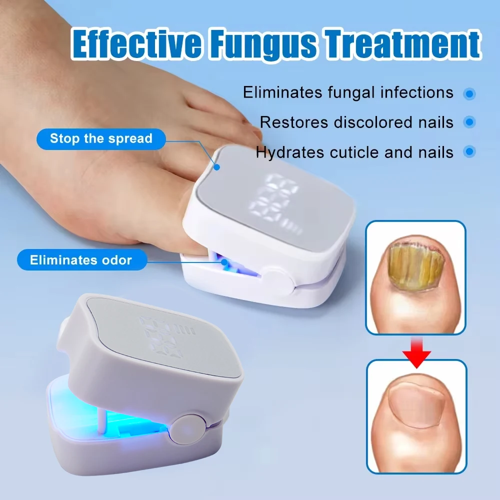 Nail Fungus Laser Treatment Effectively Remove Toenail Repair Laser for Nail Fungal Decvice Onychomycosis Therapy Treat