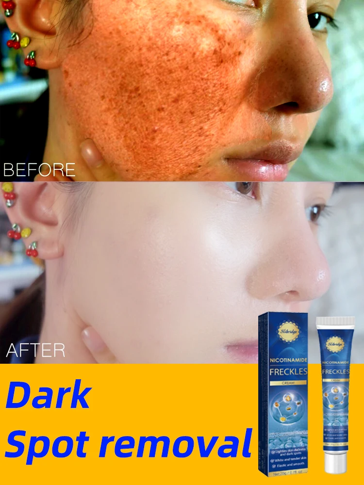 

Facial skin Care Freckles Dark Spot Removal