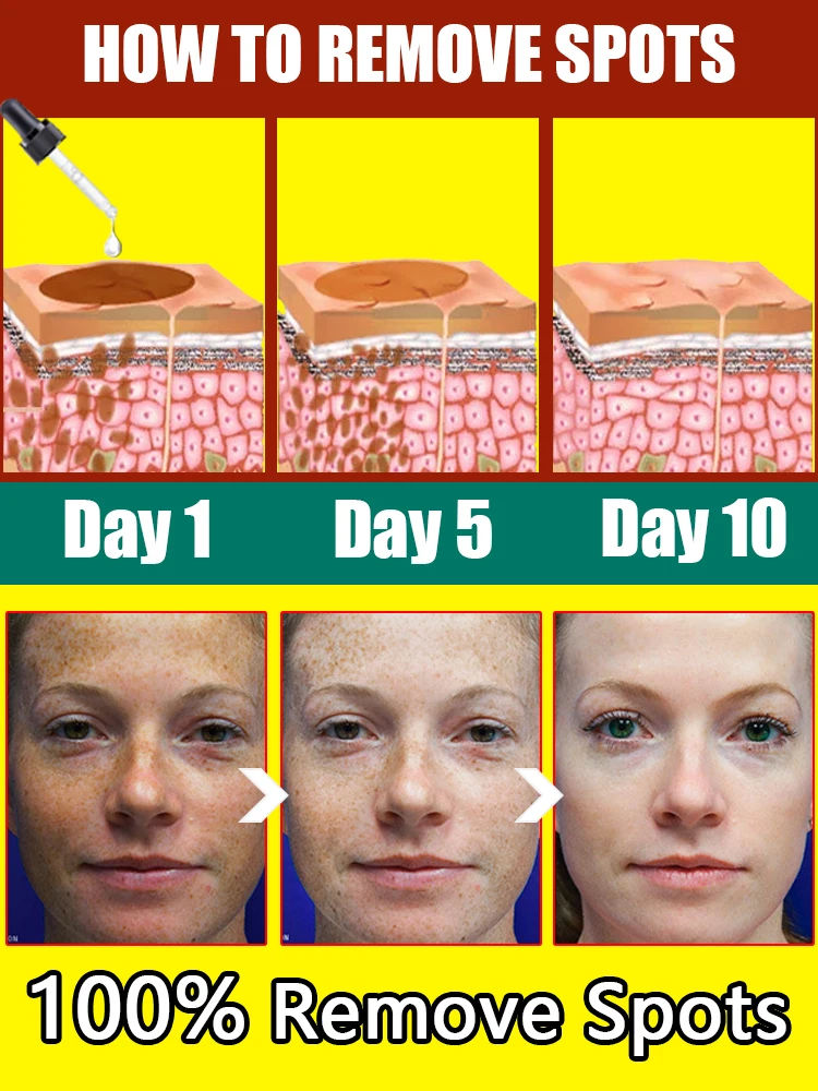 Melasma De Rosto De Remoção De Mancha Escura, Essência De Remoção De Sardas, Remoção De Depigmentação