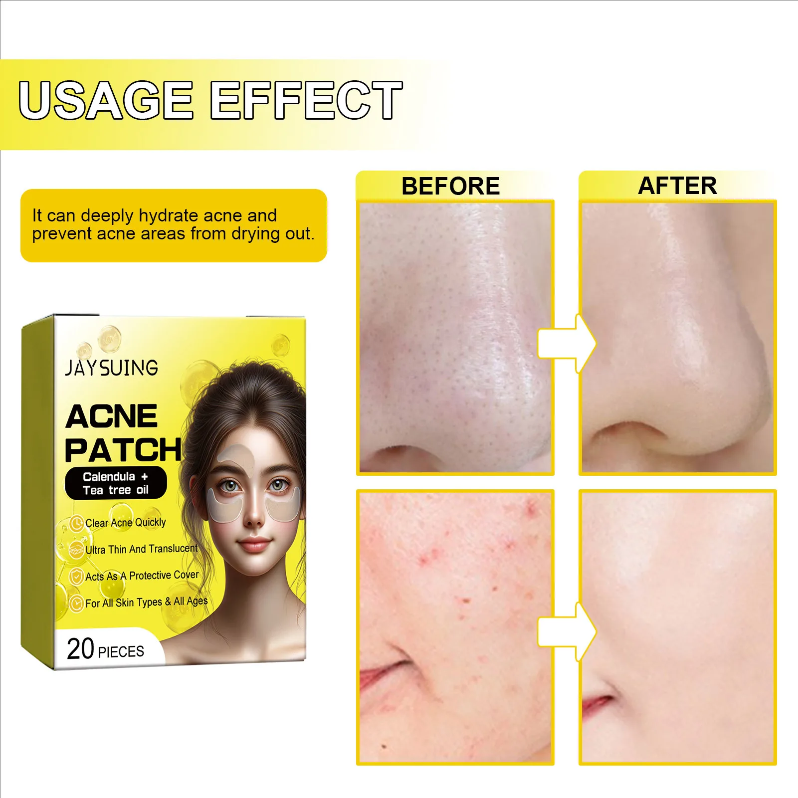 Cleansing Facial Acne Acne Closing Blackhead Removal Delicate Skin Acne Patch