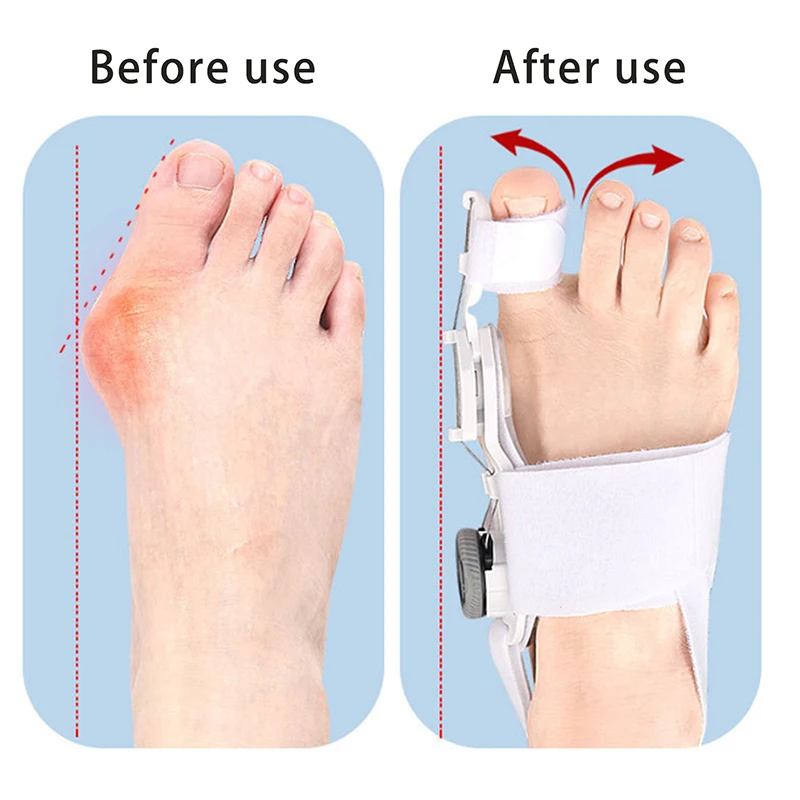 

Hallux Valgus Corrector Orthotic Bone Bundle Corrector Thumb Straightener Foot Pain Relief