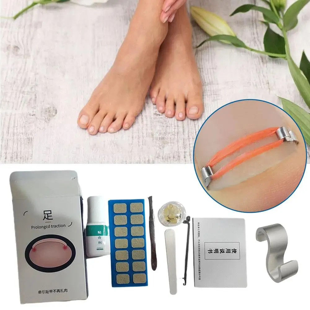 Nail Groove Ingrown Toenail Corrector Comfortable Conductive Ingrown Toenail Restore Natural Shape Nail Socket Orthotics Care