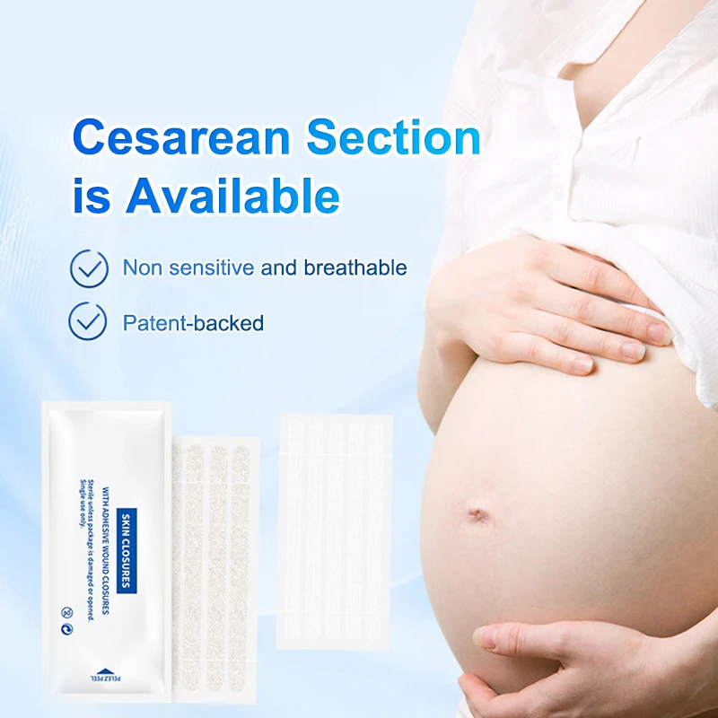 1 sacchetto di strisce di chiusura della pelle della ferita dopo il parto riparazione della ferita chirurgia estetica striscia adesiva nastro chirurgico senza sutura medica