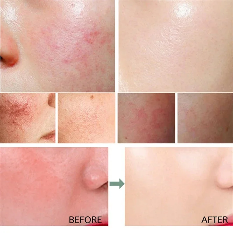 B5 إصلاح احمرار الوجه كريم لحظة العنكبوت الوريد إزالة الجلد الحساسة تهدئة مكافحة احمرار Rosacea علاج غسول مستحضرات التجميل الكورية #4
