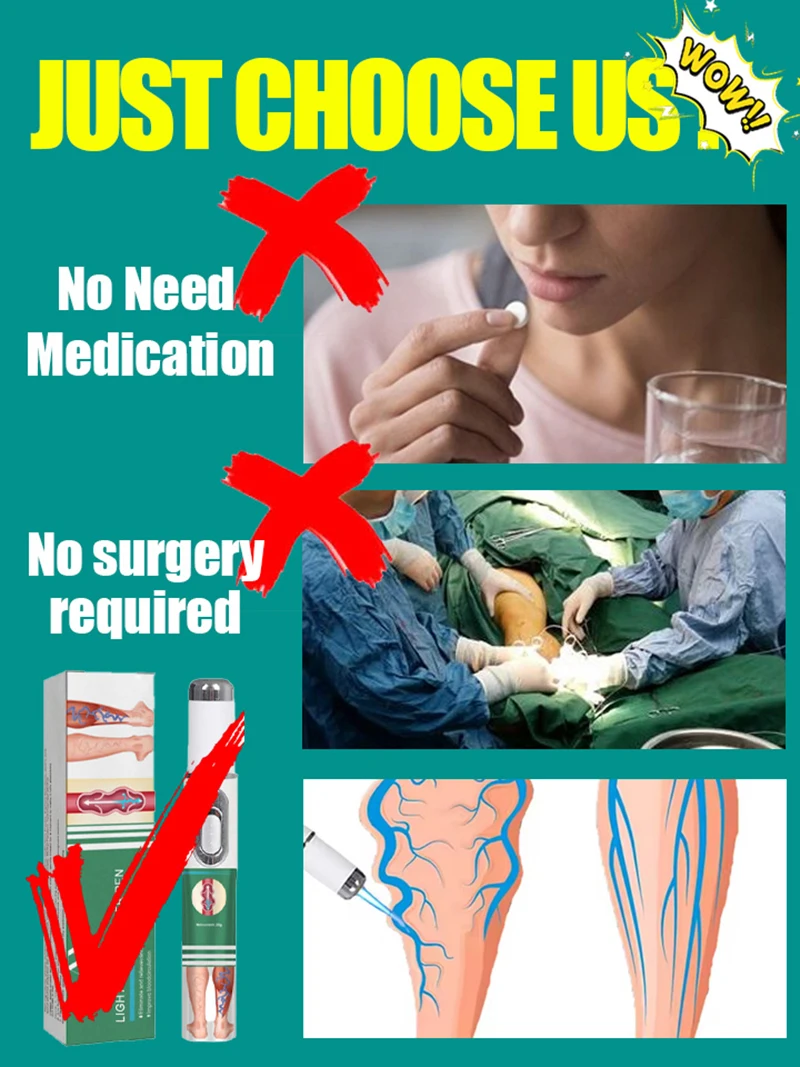 قلم الضوء الأزرق يوفر الدوالي والساقين العنكبوتية خلال 7 أيام