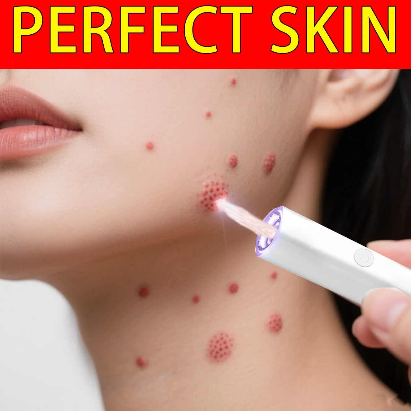 

Purple light pen can remove warts Wart removal care tools